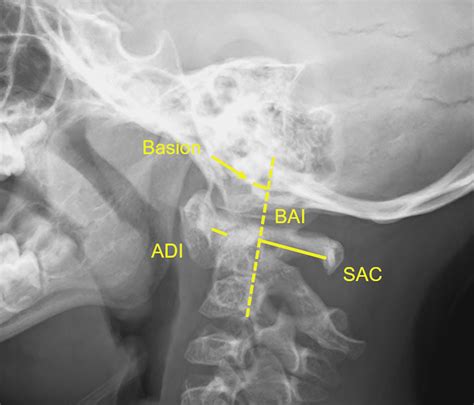 lateral adi radiology